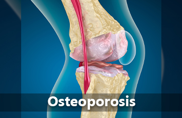 Osteoporosis tile